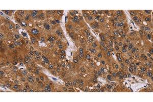 Immunohistochemistry of paraffin-embedded Human liver cancer using PPIB Polyclonal Antibody at dilution of 1:45 (PPIB antibody)