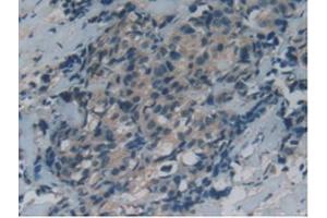 IHC-P analysis of Human Thyroid Cancer Tissue, with DAB staining. (GAS6 antibody  (AA 136-311))