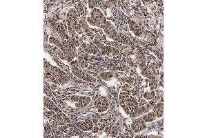 Immunohistochemical analysis of (ABIN654398 and ABIN2844139) on paraffin-embedded Human breast carcinoma tissue. (SCXA antibody  (C-Term))