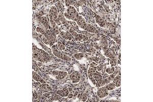 Immunohistochemical analysis of (ABIN654398 and ABIN2844139) on paraffin-embedded Human breast carcinoma tissue.