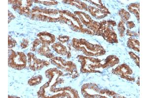 Formalin-fixed, paraffin-embedded human prostate carcinoma (10X) stained with AMACR / p504S Rabbit Monoclonal Antibody (13H4) (AMACR antibody)