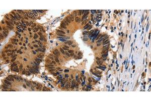 Immunohistochemistry of paraffin-embedded Human colon cancer using 14-3-3 epsilon Polyclonal Antibody at dilution of 1:100 (YWHAE antibody)