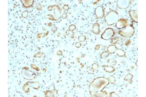 Formalin-fixed, paraffin-embedded human Renal Cell Carcinoma stained with STAT6 Mouse Monoclonal Antibody (STAT6/2410). (STAT6 antibody)