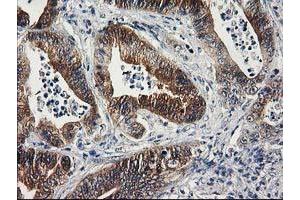 Immunohistochemical staining of paraffin-embedded Adenocarcinoma of Human colon tissue using anti-SULT1C2 mouse monoclonal antibody.