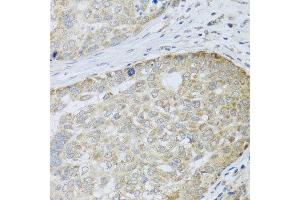 Immunohistochemistry of paraffin-embedded human liver cancer using ANAPC10 antibody at dilution of 1:100 (x40 lens).