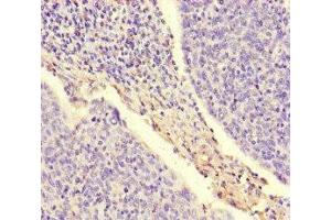 Immunohistochemistry of paraffin-embedded human cervical cancer using ABIN7169007 at dilution of 1:100 (ARAF antibody  (AA 160-310))