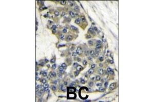 Formalin-fixed and paraffin-embedded human breast carcinoma reacted with EIF4B polyclonal antibody  , which was peroxidase-conjugated to the secondary antibody, followed by DAB staining.