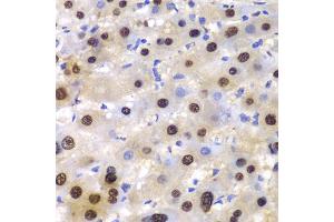 Immunohistochemistry of paraffin-embedded human liver injury using ETS1 antibody (ABIN5970774) at dilution of 1/100 (40x lens). (ETS1 antibody)
