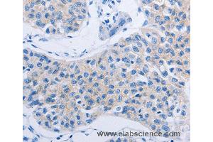 Immunohistochemistry of Human lung cancer using HOXA6 Polyclonal Antibody at dilution of 1:60 (HOXA6 antibody)