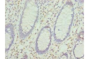 Immunohistochemistry of paraffin-embedded human colon cancer using ABIN7157478 at dilution of 1:100 (KHDRBS2 antibody  (AA 1-349))