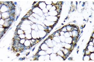 Immunohistochemistry of paraffin-embedded Human colon using HK2 Polyclonal Antibody at dilution of 1:200 (40x lens). (Hexokinase 2 antibody)