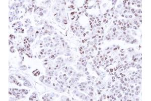 IHC-P Image Immunohistochemical analysis of paraffin-embedded OVCAR3 xenograft, using CAMK1D, antibody at 1:500 dilution.