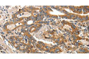 Immunohistochemistry of paraffin-embedded Human gasrtic cancer tissue using ANGPTL1 Polyclonal Antibody at dilution 1:40