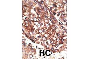 Formalin-fixed and paraffin-embedded human hepatocellular carcinoma tissue reacted with MMP13 polyclonal antibody , which was peroxidase-conjugated to the secondary antibody, followed by AEC staining. (MMP13 antibody  (C-Term))