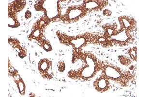 Formalin-fixed, paraffin-embedded human Breast Carcinoma stained with Calpastatin Mouse Monoclonal Antibody (CAST/1550). (Calpastatin antibody)