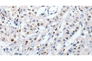 Immunohistochemistry of paraffin-embedded Human lung cancer tissue using HSPA1A Polyclonal Antibody at dilution 1:60 (HSP70 1A antibody)