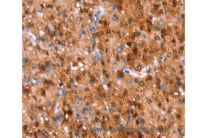 Immunohistochemistry of Human liver cancer using GH1 Polyclonal Antibody at dilution of 1:40 (Growth Hormone 1 antibody)