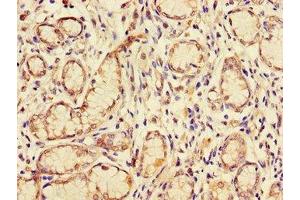 Immunohistochemistry of paraffin-embedded human gastric cancer using ABIN7153609 at dilution of 1:100 (GJB2 antibody  (AA 99-131))