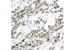 Immunohistochemistry of paraffin-embedded human breast carcinoma tissue, using Phospho-FOXO4-S197 antibody (ABIN3019724, ABIN3019725, ABIN3019726 and ABIN1681609). (FOXO4 antibody  (pSer197))
