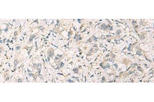 Immunohistochemistry of paraffin-embedded Human liver cancer tissue using STX6 Polyclonal Antibody at dilution of 1:60(x200)
