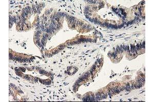 Immunohistochemical staining of paraffin-embedded Adenocarcinoma of Human colon tissue using anti-ILVBL mouse monoclonal antibody.