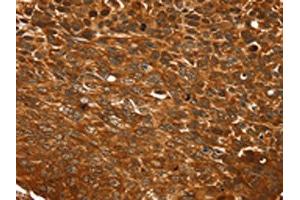 The image on the left is immunohistochemistry of paraffin-embedded Human esophagus cancer tissue using ABIN7192748(TCEB3B Antibody) at dilution 1/25, on the right is treated with synthetic peptide. (TCEB3B antibody)