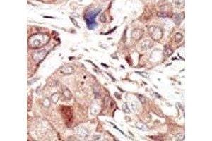 IHC analysis of FFPE human breast carcinoma tissue stained with the VEGFR2 antibody (VEGFR2/CD309 antibody  (AA 1326-1356))