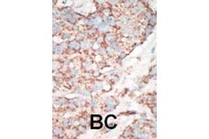 Formalin-fixed and paraffin-embedded human cancer tissue reacted with STK25 polyclonal antibody  , which was peroxidase-conjugated to the secondary antibody, followed by AEC staining.