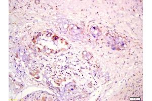 Formalin-fixed and paraffin embedded human lung carcinoma labeled with Anti-SCNN1B Polyclonal Antibody, Unconjugated (ABIN705911) at 1:200 followed by conjugation to the secondary antibody and DAB staining (SCNN1B antibody  (AA 401-500))