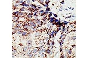 IHC analysis of FFPE human breast carcinoma tissue stained with the BAP1 antibody (BAP1 antibody  (AA 36-66))