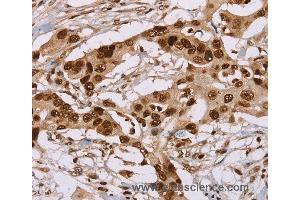 Immunohistochemistry of Human colon cancer using NUP50 Polyclonal Antibody at dilution of 1:30 (NUP50 antibody)