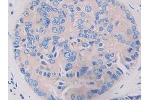 IHC-P analysis of Human Prostate cancer Tissue, with DAB staining. (LRRFIP1 antibody  (AA 615-735))