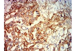 Immunohistochemical analysis of paraffin-embedded rectal cancer tissues using CTNNB1 mouse mAb with DAB staining. (CTNNB1 antibody  (AA 632-781))
