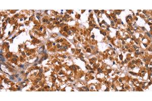Immunohistochemistry of paraffin-embedded Human thyroid cancer using GUK1 Polyclonal Antibody at dilution of 1:50