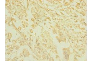 Immunohistochemistry of paraffin-embedded human pancreatic cancer using ABIN7171534 at dilution of 1:100
