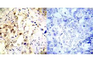 Immunohistochemical analysis of paraffin-embedded human breast carcinoma tissue using P53 (phospho- Ser20) antibody (E012030). (p53 antibody  (pSer20))