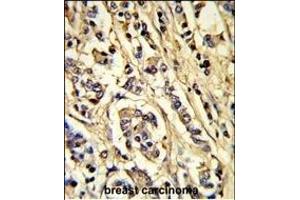 Formalin-fixed and paraffin-embedded human breast carcinoma reacted with VGFR2 Antibody, which was peroxidase-conjugated to the secondary antibody, followed by DAB staining. (VEGFR2/CD309 antibody)