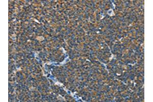 The image on the left is immunohistochemistry of paraffin-embedded Human lymphoma tissue using ABIN7131012(SEPT9 Antibody) at dilution 1/15, on the right is treated with fusion protein. (Septin 9 antibody)
