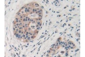 Detection of MMP19 in Human Pancreatic cancer Tissue using Polyclonal Antibody to Matrix Metalloproteinase 19 (MMP19) (MMP19 antibody  (AA 98-508))
