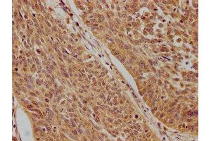 IHC image of ABIN7140203 diluted at 1:100 and staining in paraffin-embedded human cervical cancer performed on a Leica BondTM system. (Tumor Protein p73 antibody  (AA 537-555))