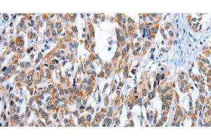 Immunohistochemistry of paraffin-embedded Human esophagus cancer tissue using EDN3 Polyclonal Antibody at dilution 1:30 (Endothelin 3 antibody)