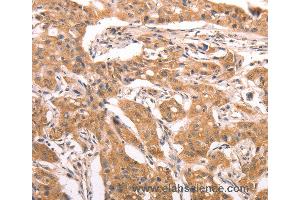 Immunohistochemistry of Human lung cancer using AASDHPPT Polyclonal Antibody at dilution of 1:30 (AASDHPPT antibody)