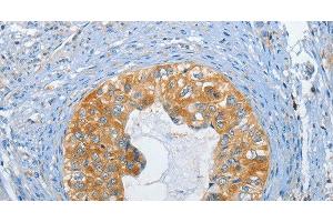 Immunohistochemistry of paraffin-embedded Human cervical cancer tissue using DGK zeta Polyclonal Antibody at dilution 1:60 (DGKZ antibody)