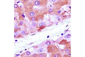 Immunohistochemical analysis of Annexin A4 staining in human liver cancer formalin fixed paraffin embedded tissue section. (Annexin IV antibody)