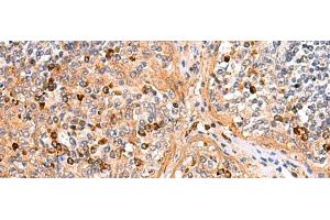 Immunohistochemistry of paraffin-embedded Human liver cancer tissue using KANSL1L Polyclonal Antibody at dilution of 1:40(x200) (KANSL1L antibody)