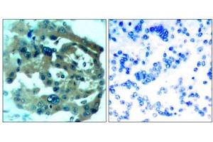 Immunohistochemical analysis of paraffin-embedded human lung carcinoma tissue, using Merlin (Ab-518) antibody (E021258). (Merlin antibody)