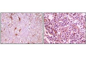 Immunohistochemical analysis of paraffin-embedded human thalamus (left) and glioma (right) tissue, showing membrane localization using CIB1 mouse mAb with DAB staining. (CIB1 antibody)