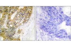 Immunohistochemistry analysis of paraffin-embedded human colon carcinoma tissue, using MDM2 (Ab-186/188) Antibody. (MDM2 antibody  (AA 151-200))