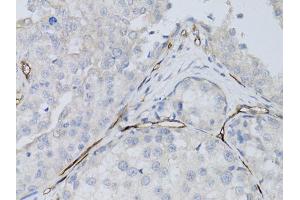 Immunohistochemistry of paraffin-embedded human breast cancer using CD34 antibody (ABIN5970285) at dilution of 1:50 (40x lens). (CD34 antibody)