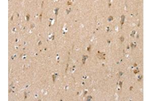 The image on the left is immunohistochemistry of paraffin-embedded Human brain tissue using ABIN7192520(SLC6A8 Antibody) at dilution 1/30, on the right is treated with synthetic peptide. (SLC6A8 antibody)